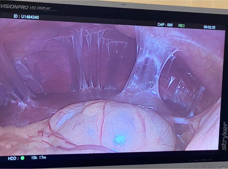Arquivo pessoal. Aderências ao redor do fígado, sugere doença inflamatória pélvica (DIP) achado em inventário de laparoscopia para cirurgia ginecológica.