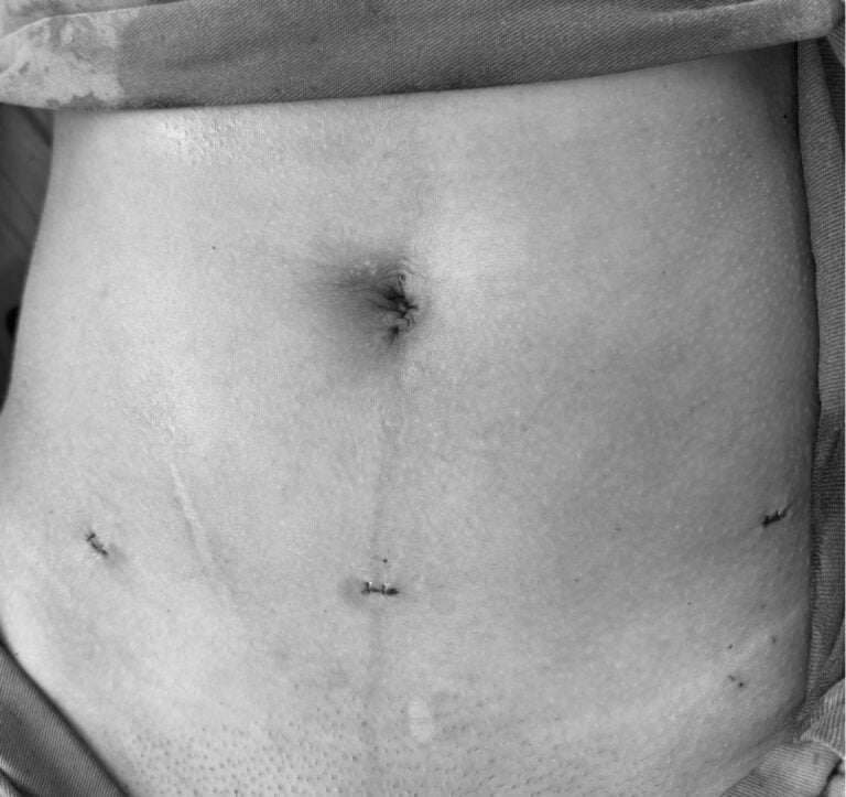 Imagem de arquivo pessoal. Foto retirada após cirurgia para exérese de focos de endometriose: foram colocados 3 trocateres de 5mm e 1 trocater de 10mm em região umbilical